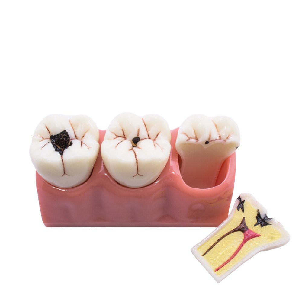 0905101-Modelo-implante-nervio-1.jpg Modelo Desmontable Caries Bader - Imagen 1