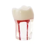 Molar con Conductos Radiculares Bader