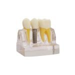 Modelo demostración de implantes Bader