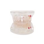 Modelo transparente de caries Bader