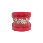 Modelo de Bracket Metálico y zafiro Bader